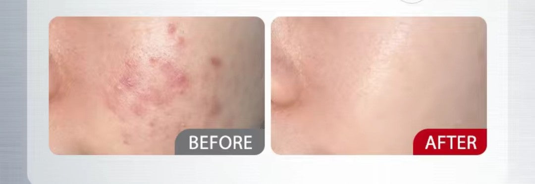 Before and after results using Ning Anti-Acne Serum for acne treatment