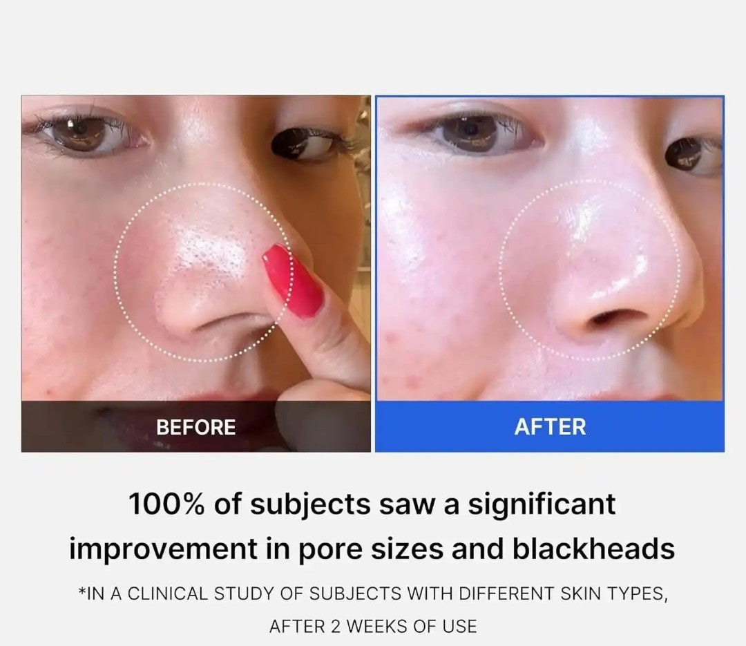 Before and after comparison of skin with a focus on pores and blackheads, showing a significant improvement.