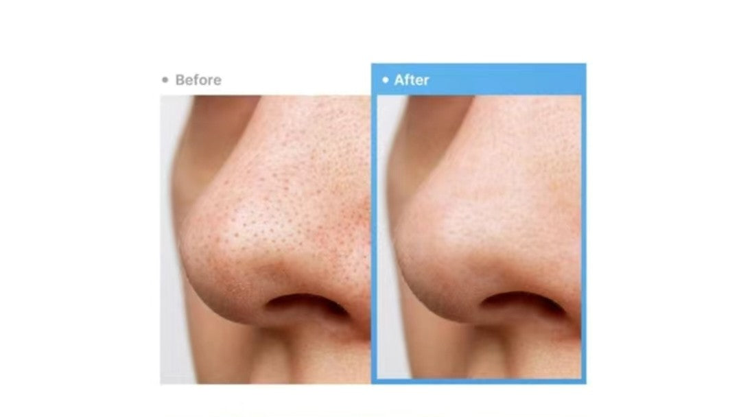 Before and after comparison of a nose with skin treatment