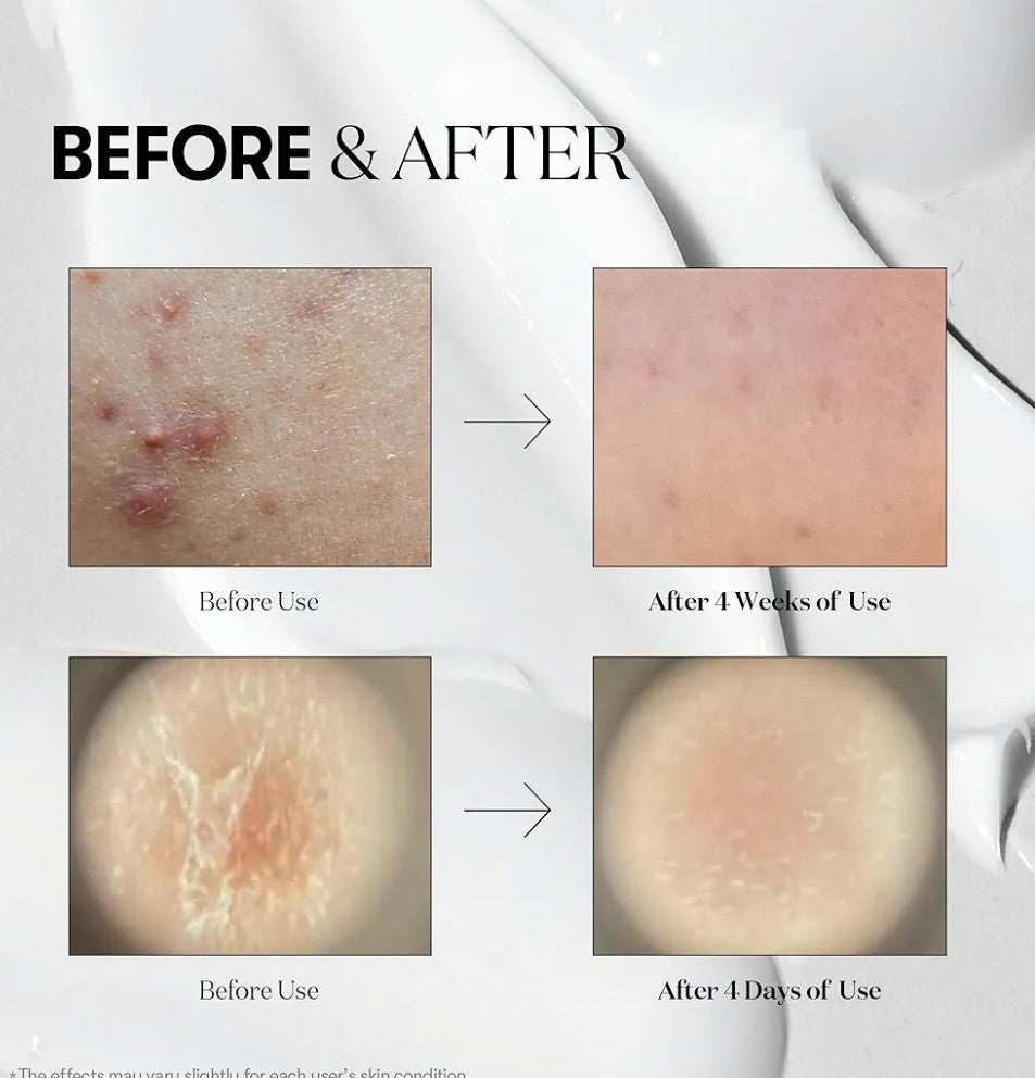 Before and after skin treatment results showing improvement over time.