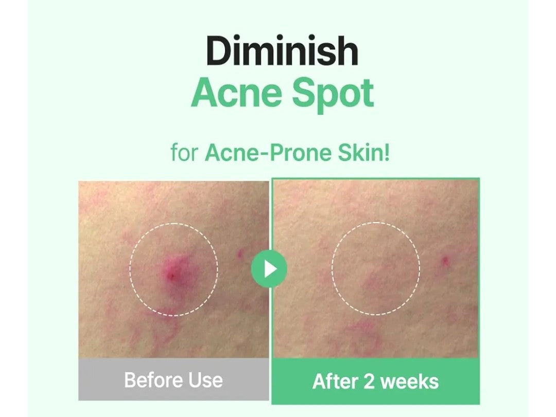 Before and after comparison of acne spot treatment on skin with 'Diminish Acne Spot' text.