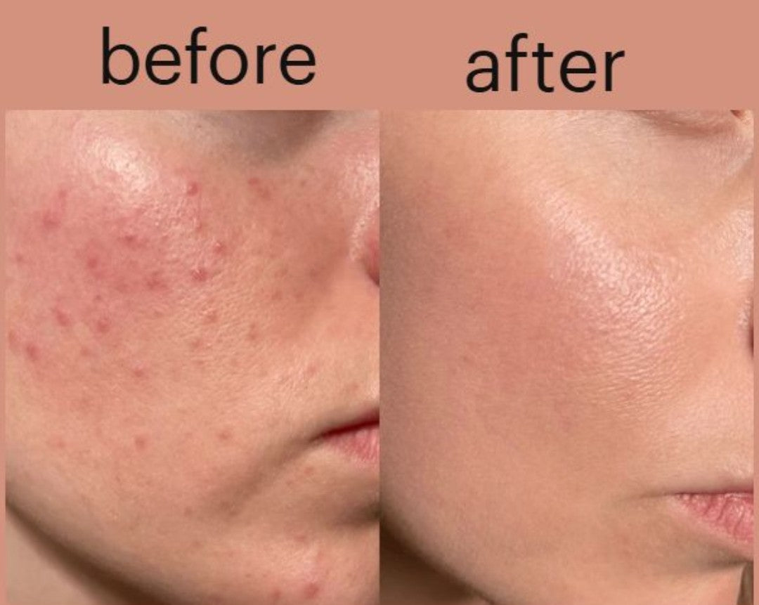 Complete Acne & Glow Routine