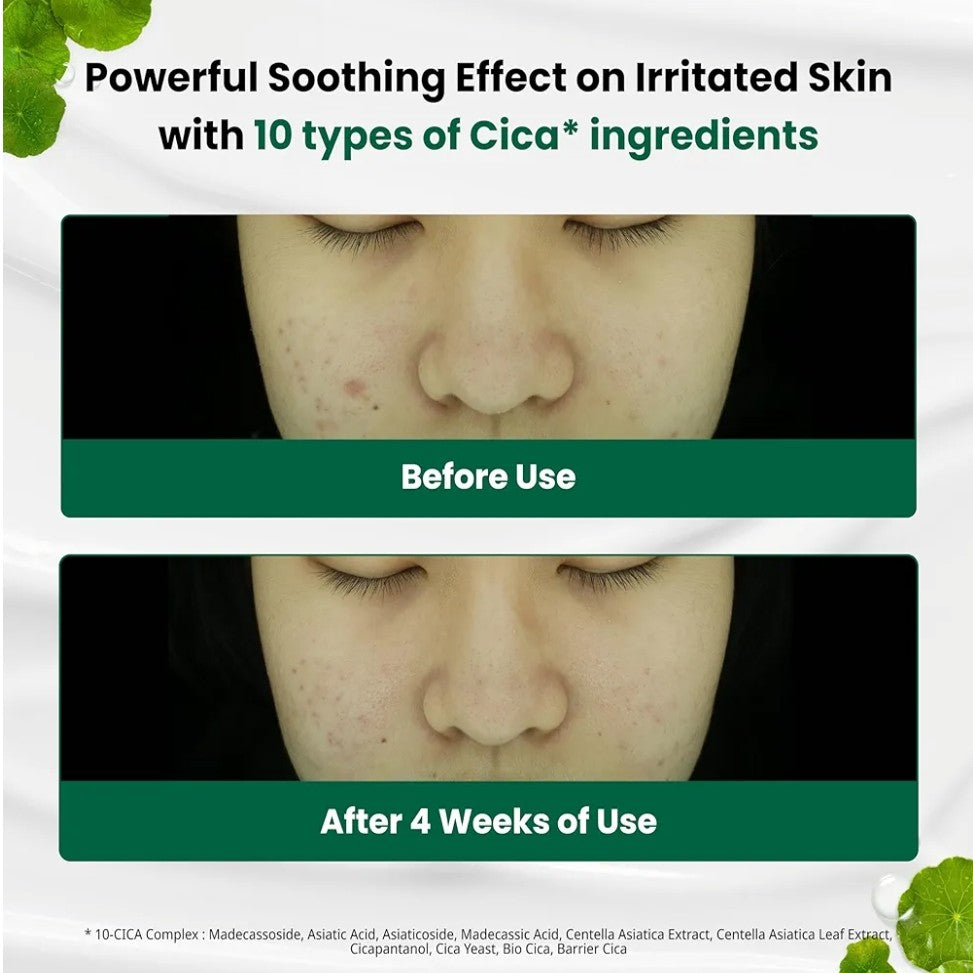 Hypoallergenic non-comedogenic moisturizer suitable for acne-prone skin