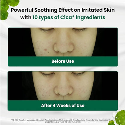Hypoallergenic non-comedogenic moisturizer suitable for acne-prone skin