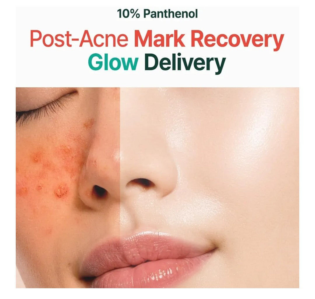 Before and after comparison of post-acne mark recovery with 10% Panthenol on a person's face.