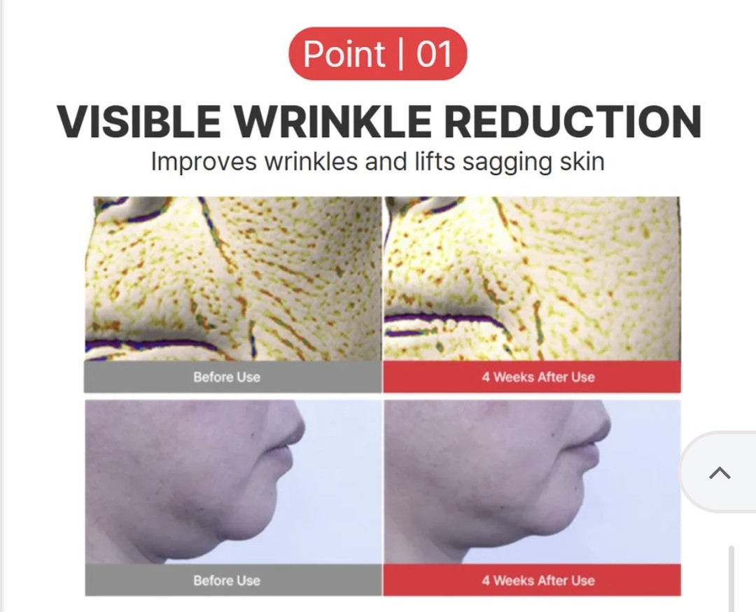 Before and after comparison of wrinkle reduction treatment on skin